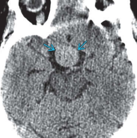 Spindle Cell Oncocytoma (SCO) của tuyến yên