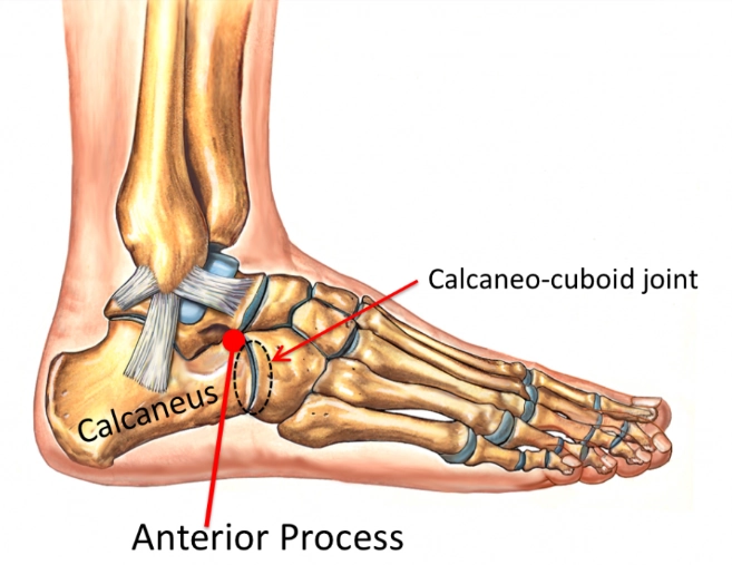 Gãy mỏm trước xương gót (Anterior calcaneal process fracture)