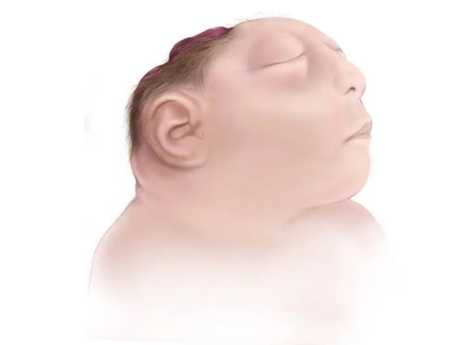 Chuối dị tật vô sọ- mất não (Exencephaly- Anencephaly)