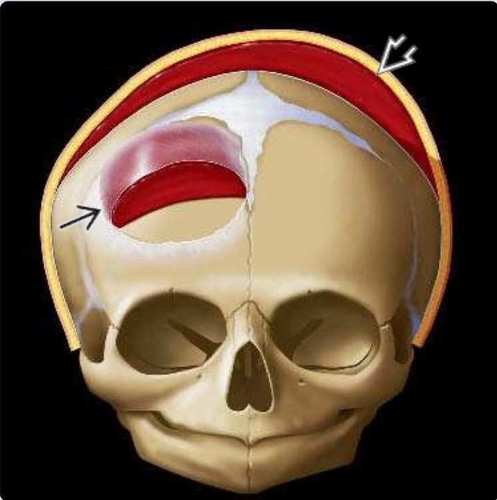 Chấn thương sọ não (Traumatic brain)