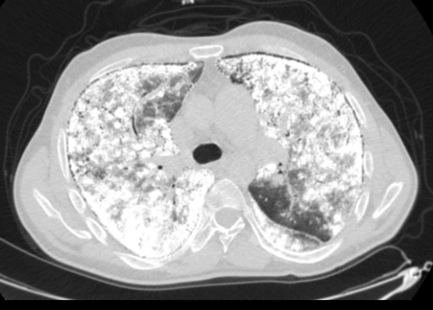 Bệnh vi sỏi phế nang phổi (Pulmonary alveolar microlithiasis - PAM)