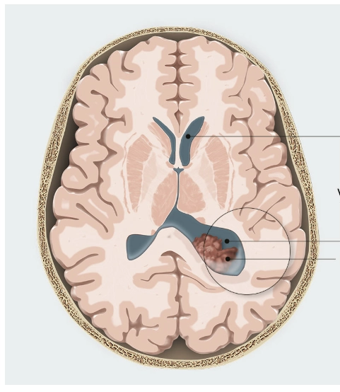 U nhú đám rối mạch mạc thai nhi (Choroid Plexus Papilloma - CPP)