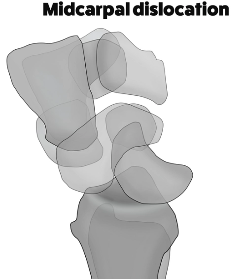 Trật khớp giữa các hàng xương cổ tay (Midcarpal dislocation)