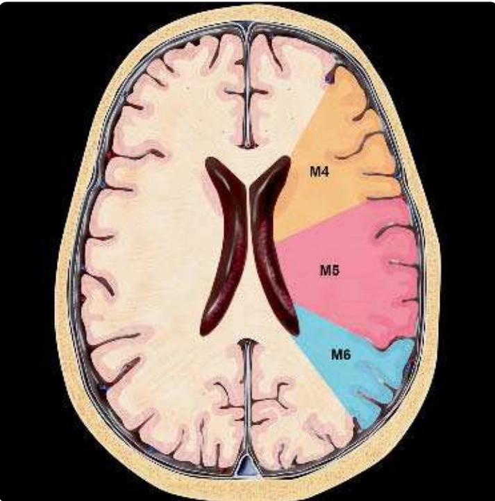 Đột quỵ (Stroke)