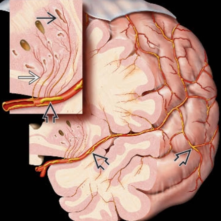 Bệnh lý xơ vữa động mạch trong sọ (Intracranial Atherosclerosis)