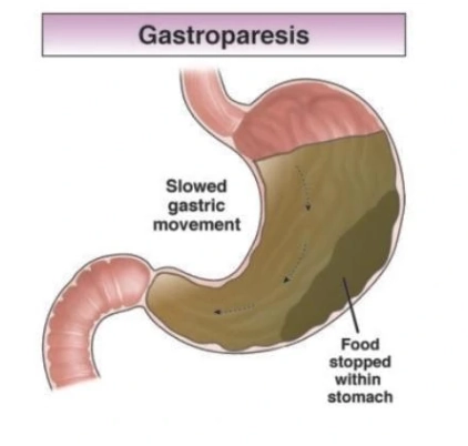 Liệt dạ dày (Gastroparesis)