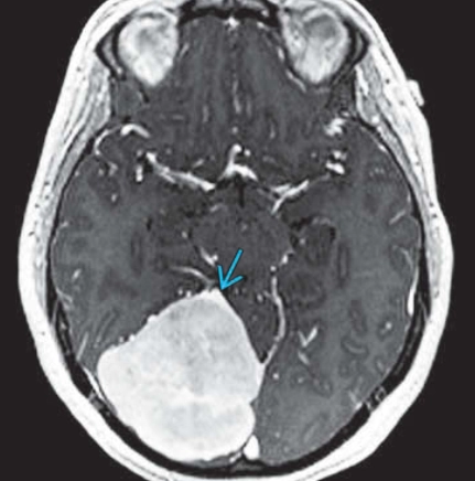 Hội chứng Li-Fraumeni (Li-Fraumeni syndrome)