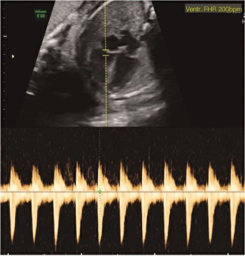 Rối loạn nhịp nhanh