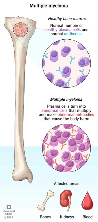 Đa u tủy (Multiple Myeloma - MM)