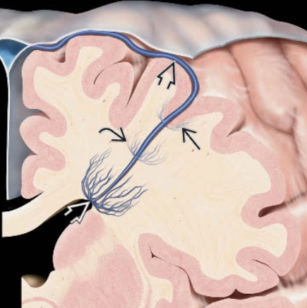 Bất thường phát triển tĩnh mạch (Developmental Venous Anomaly - DVA)