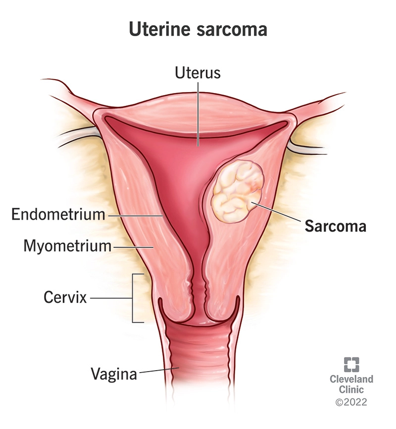 Sarcoma cơ trơn tử cung (Uterine Leiomyosarcoma)