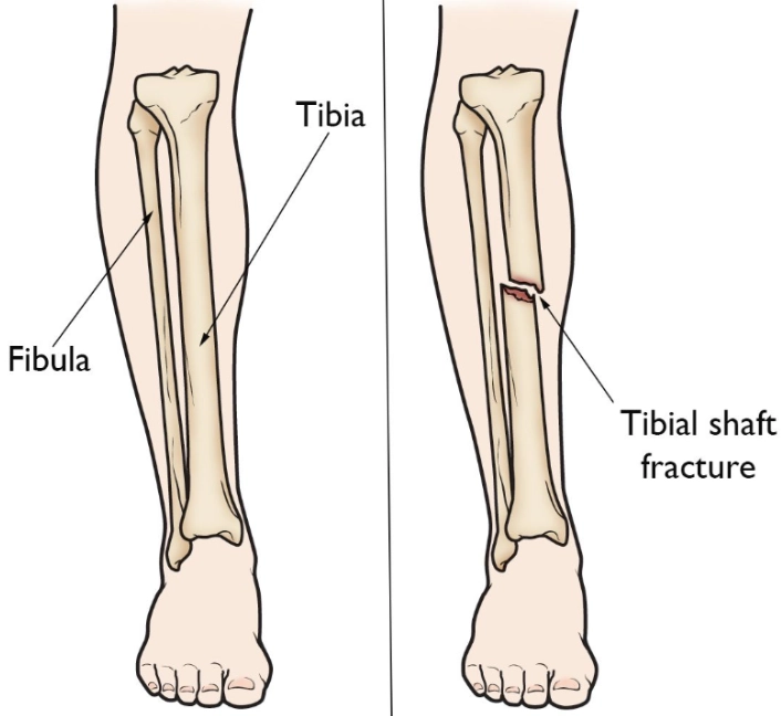 Gãy thân xương chày (Tibial shaft fracture)