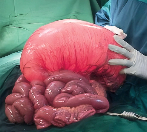 Phù mạch ruột (Intestinal angioedema)