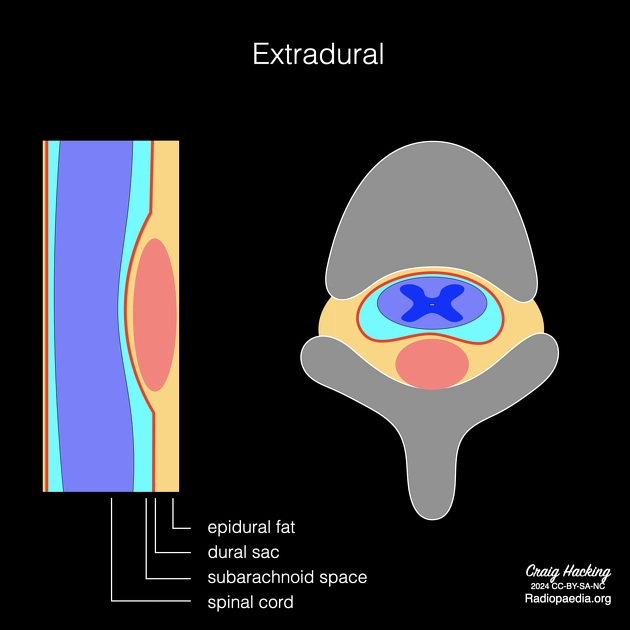 Các khối u hoặc tổn thương giả u ngoài màng cứng (Extradural mass)
