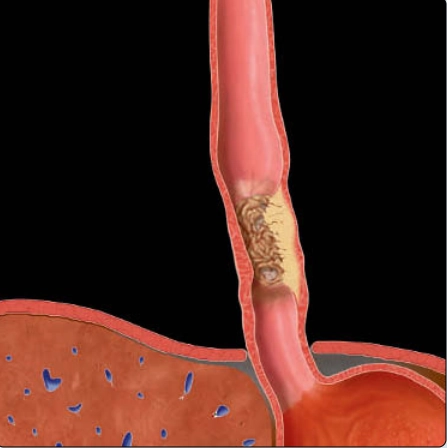 Ung thư thực quản (Esophageal Carcinoma)