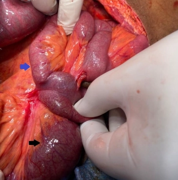 Tắc ruột quai kín (Closed Loop Obstruction)