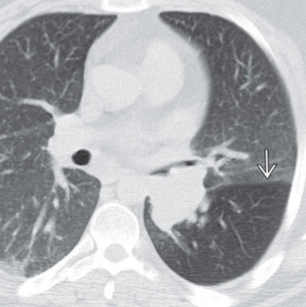 Dấu hiệu bẫy khí (Air-trapping)