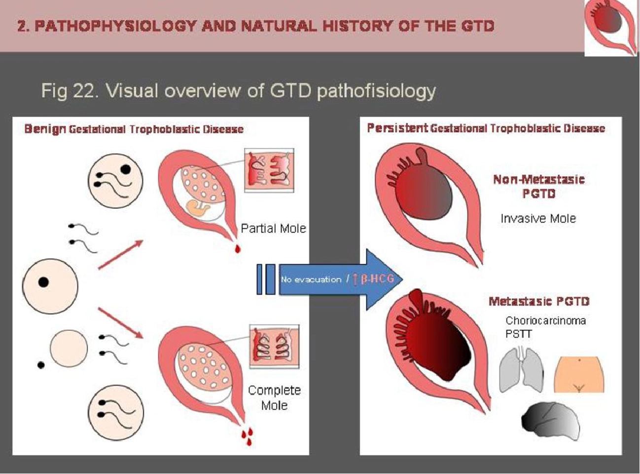 Thai trứng xâm lấn (Invasive mole)