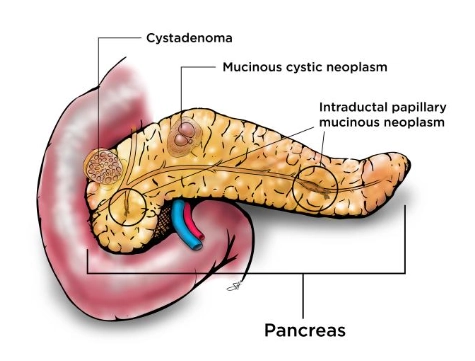 U nhầy nhú trong ống tụy (Intraductal Papillary Mucinous Neoplasm - IPMN)