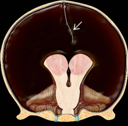 Não nước / Khuyết não bán cầu (Hydranencephaly)