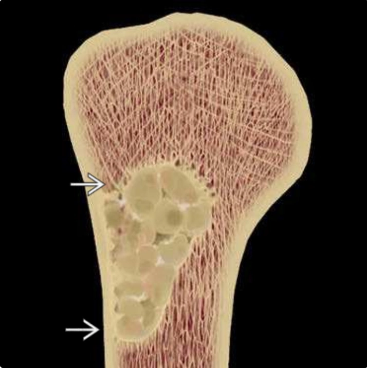 Tiếp cận u xương (Approach to bone tumors)
