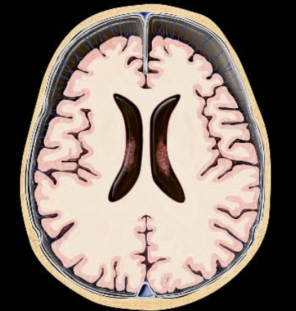 Giãn rộng lành tính dưới nhện ở trẻ nhũ nhi (Benign Enlargement of the Subarachnoid Space in Infancy - BESS)
