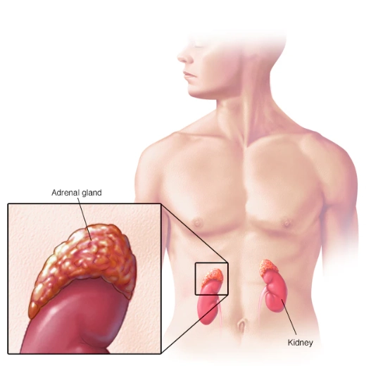 U nguyên bào thần kinh (Neuroblastoma)