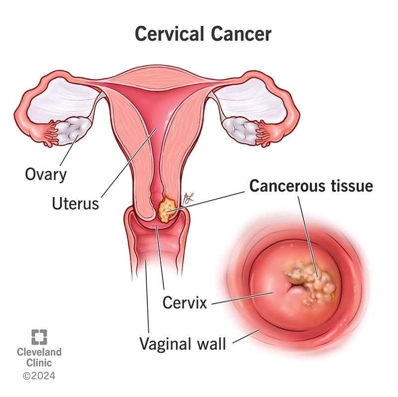 Carcinoma cổ tử cung (Cervical carcinoma)