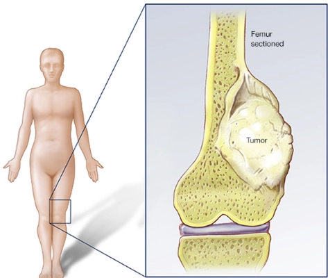 Tổng quan u xương (Bone tumors)