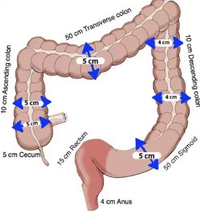 Giả tắc đại tràng cấp/ Hội chứng Ogilvie (Colonic pseudo-obstruction)