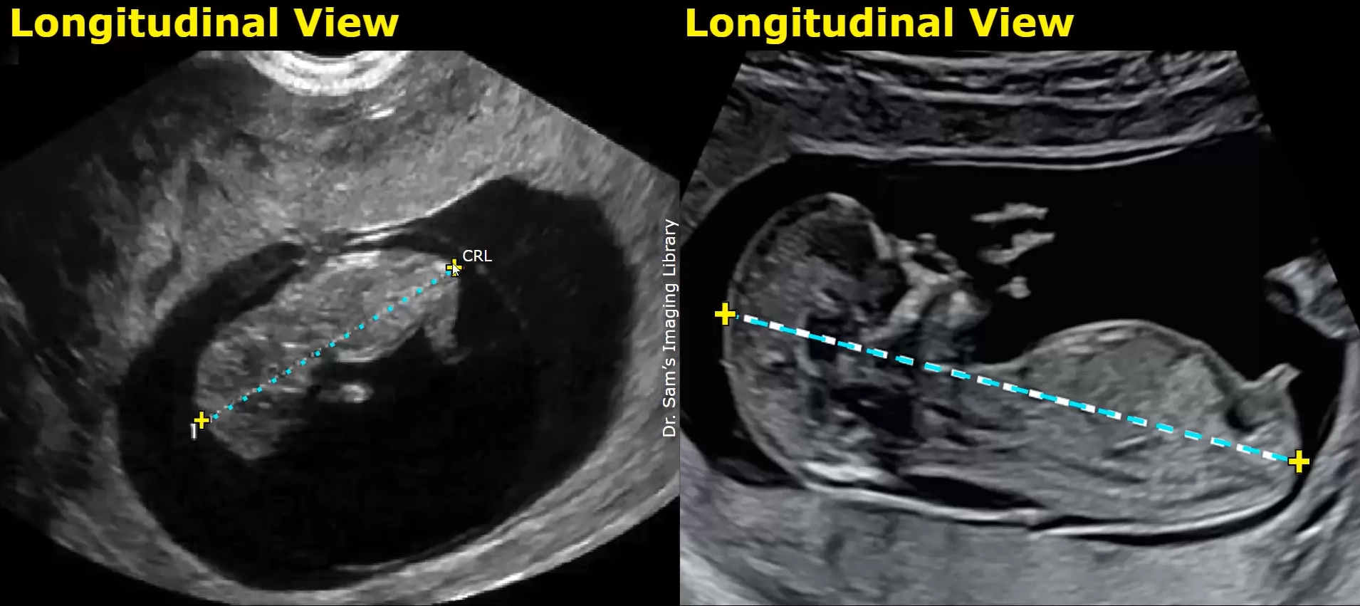 Sinh trắc học và xác định tuổi thai (biometry &amp; dating)