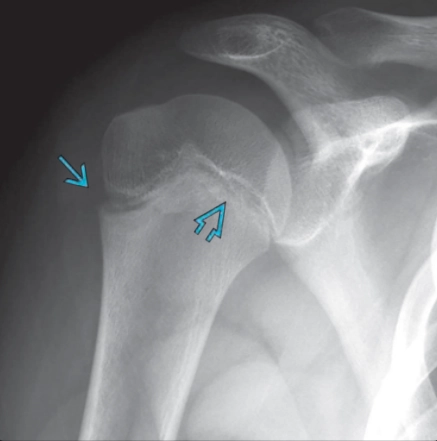 Hội chứng vai của cầu thủ ném bóng nhí- Little Leaguer's Shoulder