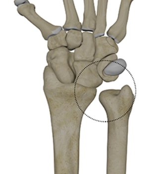 Mất vững khớp quay trụ dưới (Distal Radioulnar Joint Instability)