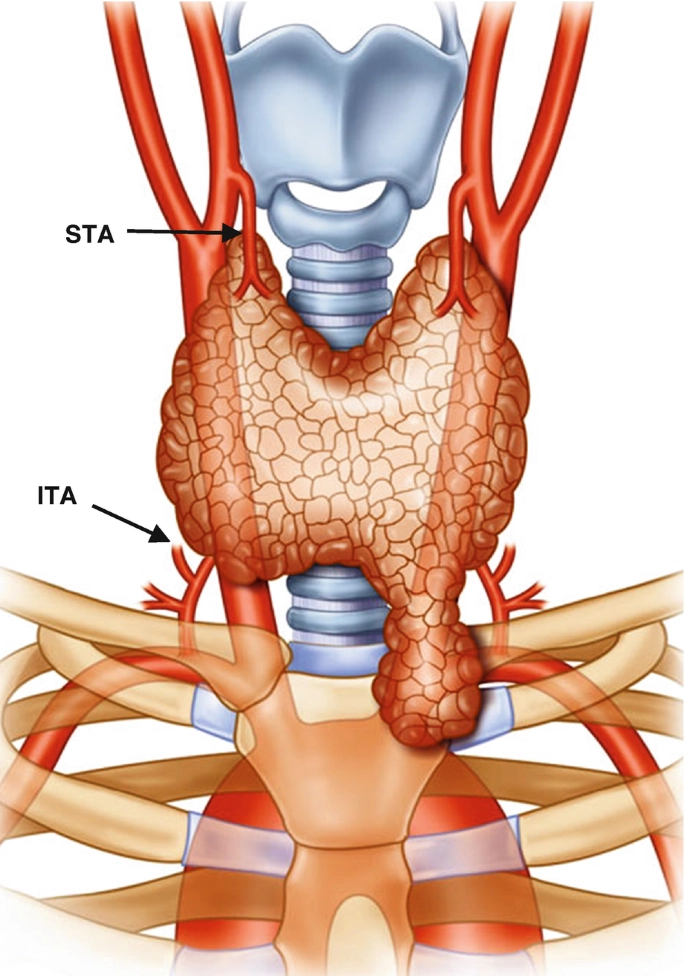 Bướu giáp sau xương ức (Retrosternal goiter)