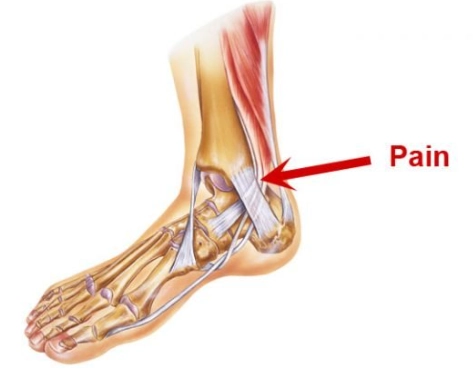 Rối loạn chức năng gân chày sau (Tibialis posterior dysfunction)