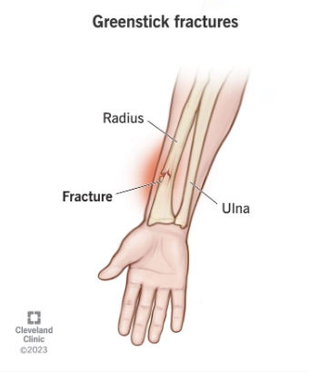 Gãy cành tươi (Greenstick fracture)