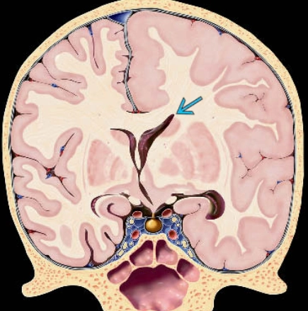 To một bên bán cầu não (Hemimegalencephaly - HMEG)