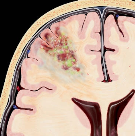 Áp xe não (Cerebral abscess)