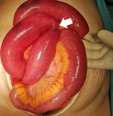 Thoát vị qua dây chằng rộng (Broad Ligament Hernia)