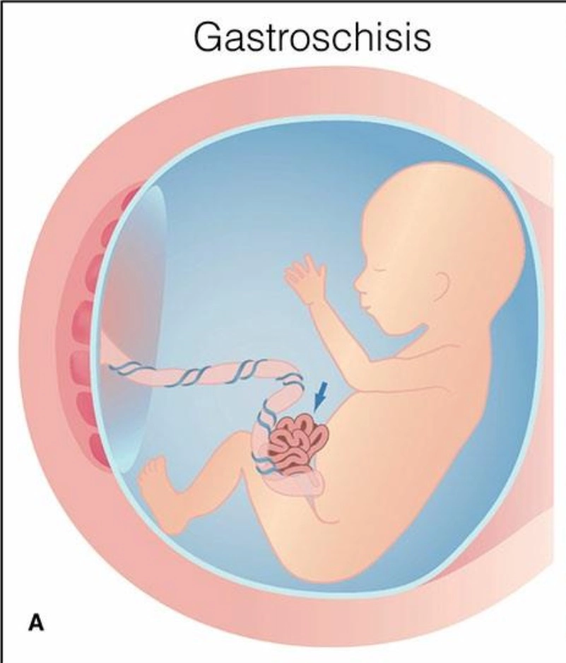 Hở thành bụng thai quý I (Gastroschisis)