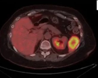 Di căn lách (Splenic metastases)