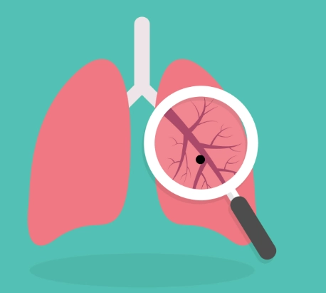 Sàng lọc Ung thư Phổi (Lung Cancer Screening)