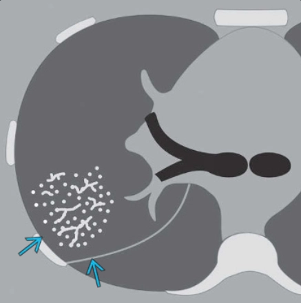 Dấu hiệu chồi cây (Tree-in-bud pattern) 