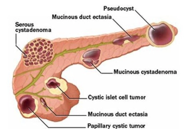 Nang giả tụy (Pancreatic pseudocyst)