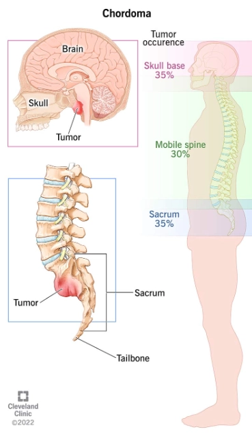 U dây sống ác tính (Sarcoma Chordoma)