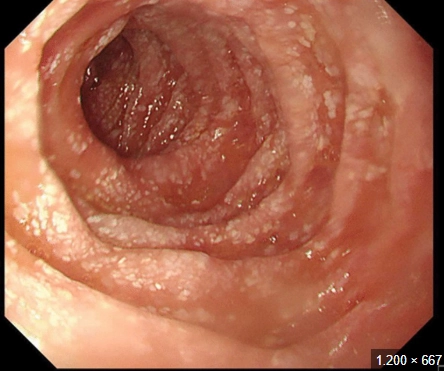 Giãn bạch mạch ruột (Intestinal Lymphangiectasia)