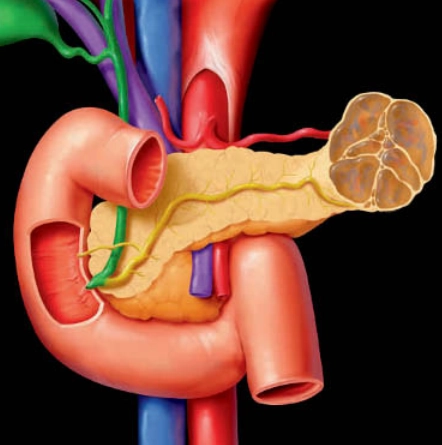 U nang tuyến nhầy của tụy (Mucinous Cystic Neoplasm - MCN)