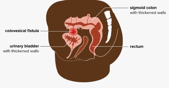 Rò đại tràng-bàng quang (Colovesical fistula)