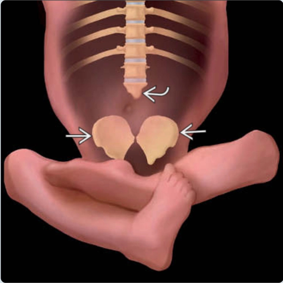 Thoái hóa cột sống bẩm sinh (Caudal Regression Sequence)