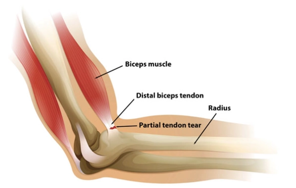Tổn thương gân cơ nhị đầu ở khuỷu (Biceps Tendon Injury, Elbow)